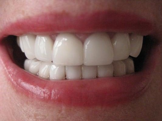 Veneers & Crowns - After