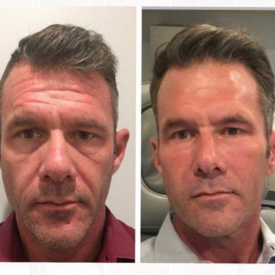 Proof you gentlemen can still look manly with Botox and fillers. Consistency and trusting the process is the key.