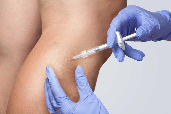 Sclerotherapy is a highly effective and safe method of treating various forms of varicose veins.