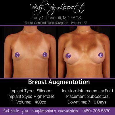 Before and after breast augmentation. Silicone Gel Breast Implants. #breastaugmentation #breastimplants