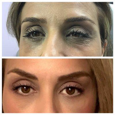 Tear trough fillers can bring about dramatic changes !