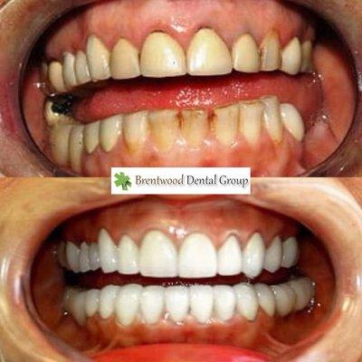 Smile Makeover - Before / After Dr. Haroun Rostami, DDS