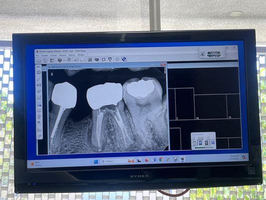 Look at how beautiful my NEW ROOT CANAL is!!! I'm so so happy! I'm literally crying!