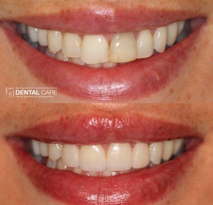 Only 4 veneers to perfect her smile