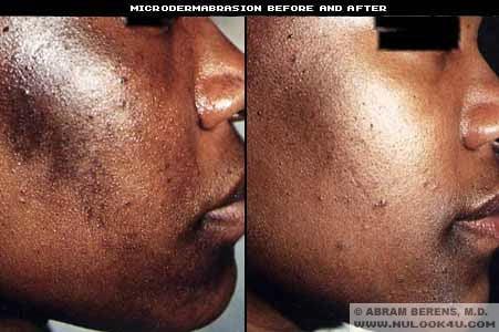 Medical Peels, Microdermabrasion,