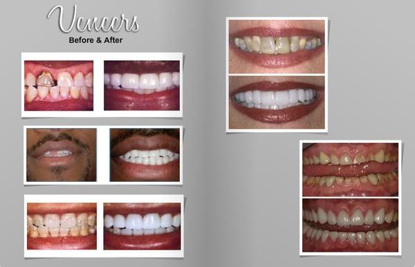 Veneer before and afters