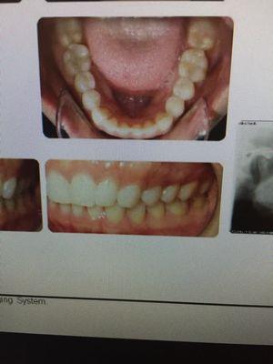 This was my teeth before treatment