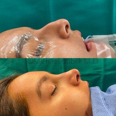 Rhinoplasty performed by Dr. Bublik