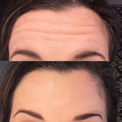 Botox treatment to frown lines and forehead lines helped smooth out client's horizontal frown lines.