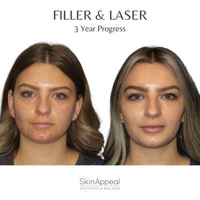 Dermal Filler & Laser