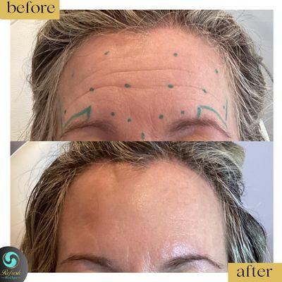 Client had concerns of static (present at rest) wrinkles across her forehead.  She was treated with Daxxify. Pictures taken 2 weeks apart.