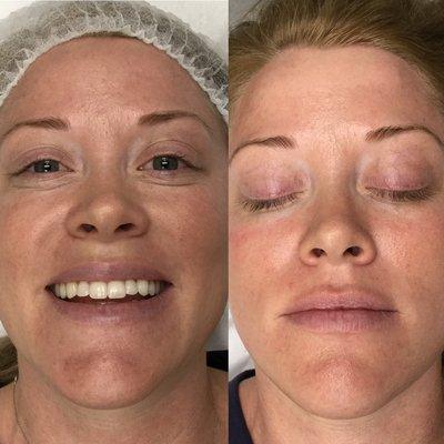 Dermaplaning Before & After