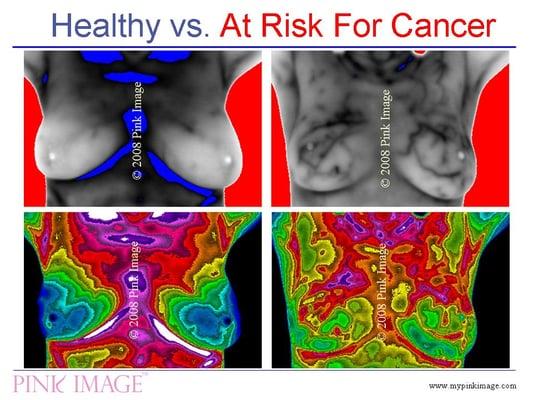 Pink Image Breast Thermography