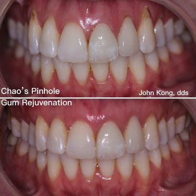 Chao Pinhole Technique for scalpel-less, suture-less correction of gum recession.