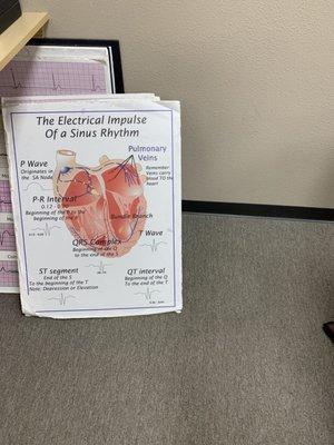 I 3 Sinus Rhythm