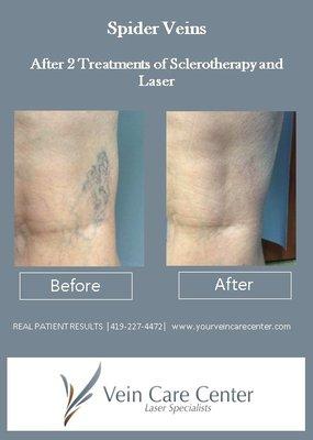 Results after a combination of sclerotherapy and laser.