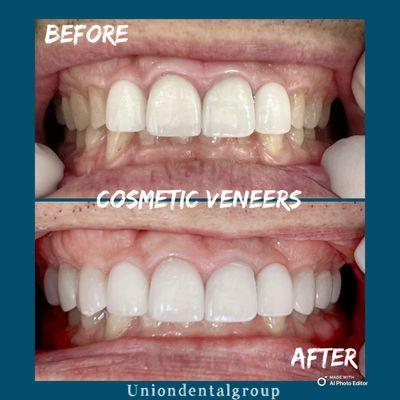 We do cosmetic veeners here! Call to make your appointment with us at (714) 533-0900