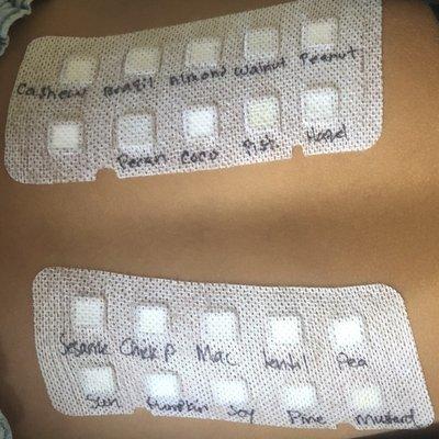 the patch test - they wear this overnight, and document the results the next day