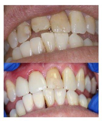 Side by side comparison of Ugly crown and Esthetic crown..