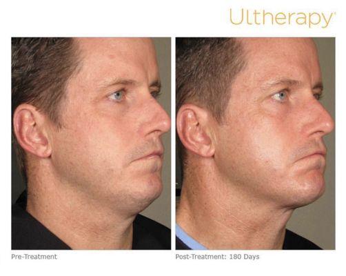 Ultherapy is a non-invasive treatment that improves lines and wrinkles.