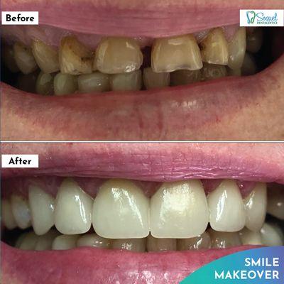 Smile makeover by Dr. Shyba at Soquel Dental Office.