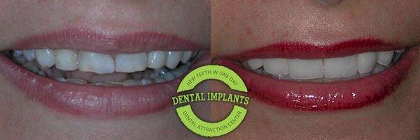 Veneer - Before & After