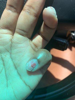 Damaged and bleeding nail