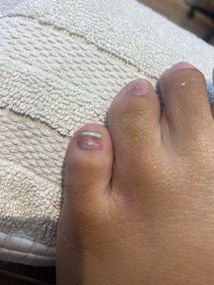 Ripped off pinky toe