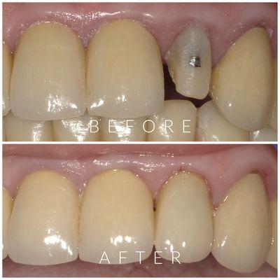 Porcelain Crown Restoration by Dr. Tatyana Yashchuk.