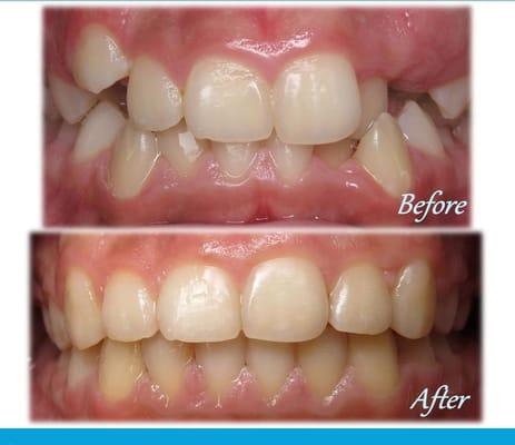 Orthodontic treatment done by Dr.Suarez.