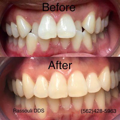 Invisalign treatment. Completed in about 15 months. Great results. Very happy patient. Call us for a free consultation. (562)428-5963.