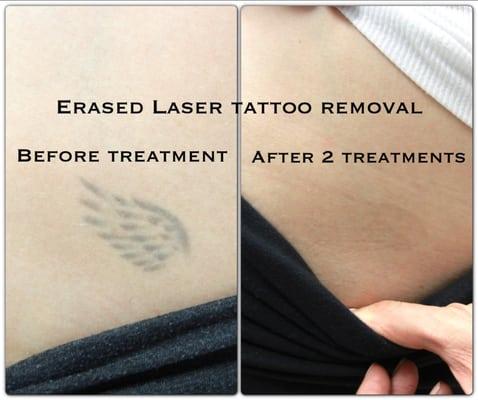 After the 2nd treatment. Erased Tattoo Removal Las Vegas www.erasedlasertattooremoval.com