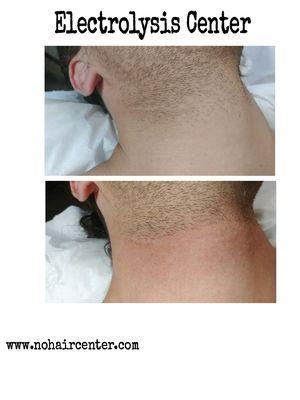 Before & after on neck area