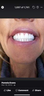 My smile.  Thanks to Dr Erini Redmond's!