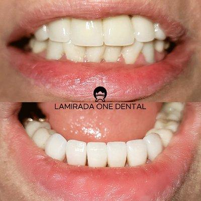 Beautiful smile with new crowns & Veneer