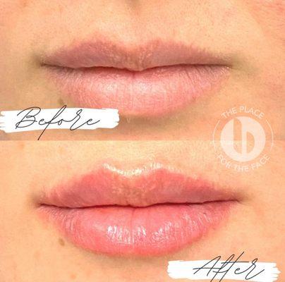 Get the perfect pout with dermal fillers at Bevelup