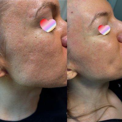 Left is before 1 Microneedling session, right is after 1