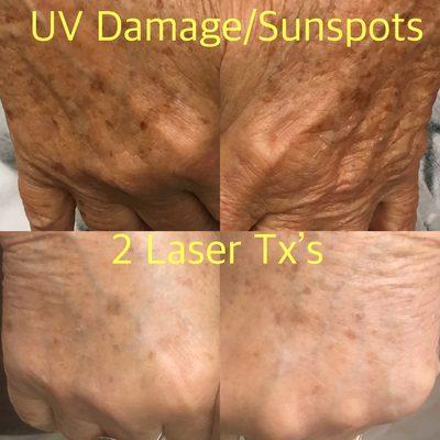 Lessen the appearance of UV damage/sunspots with laser treatments