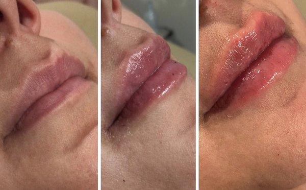 0-1-2 ML lip filler lasts 6-9 months