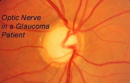 We specialize in glaucoma diagnosis & treatment