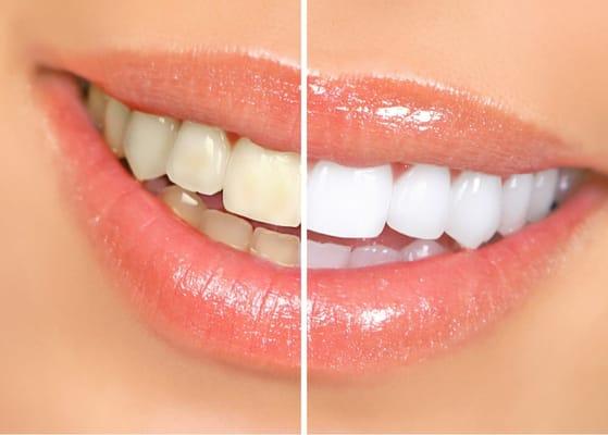 Professional whitening available!