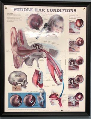 Explaining middle ear conditions.