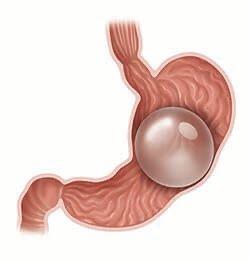 ORBERA Gastric Balloon