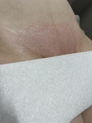 Brazilian Wax After Results