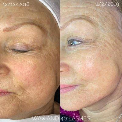 Microneedling results