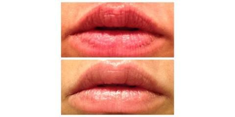 Lip Renewing Serum Can Improve Your Lips in Just One Night