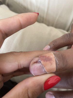 Finger that is missing skin