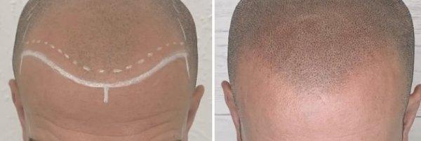 Scalp micro pigmentation