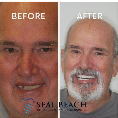 Seal Beach Dental Implants