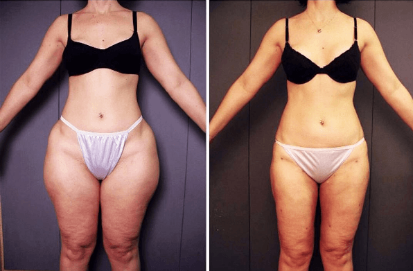 Lower body lipo.